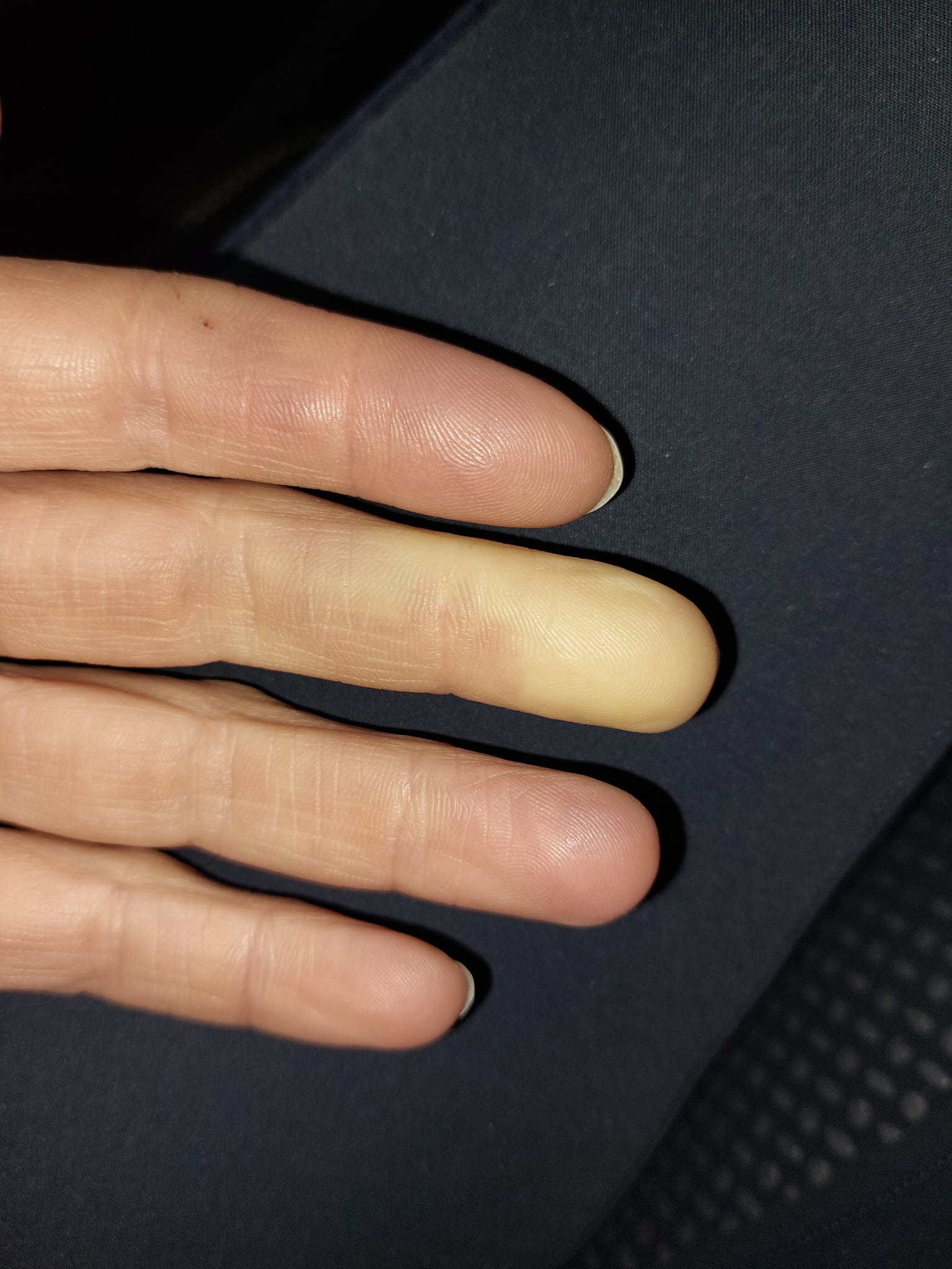 fenomeen van Raynaud anke met kind